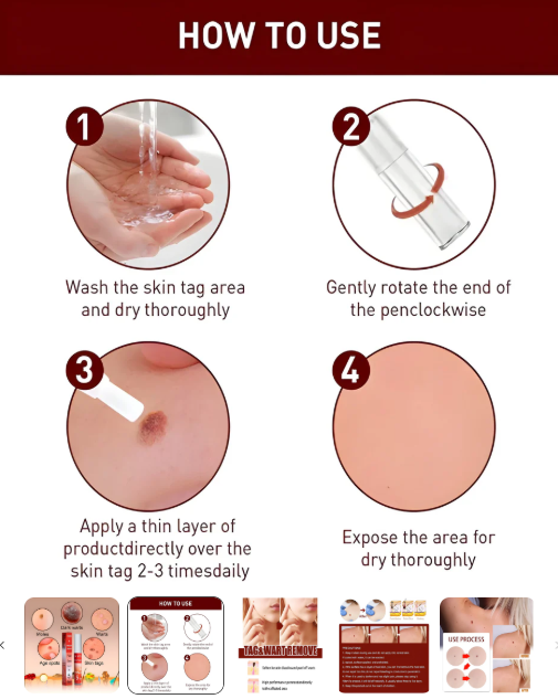 Professional Skin Tag & Mole Removal Device – Flawless Skin At Home - Vistora